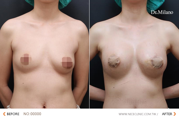 提乳手術案例 圖片
