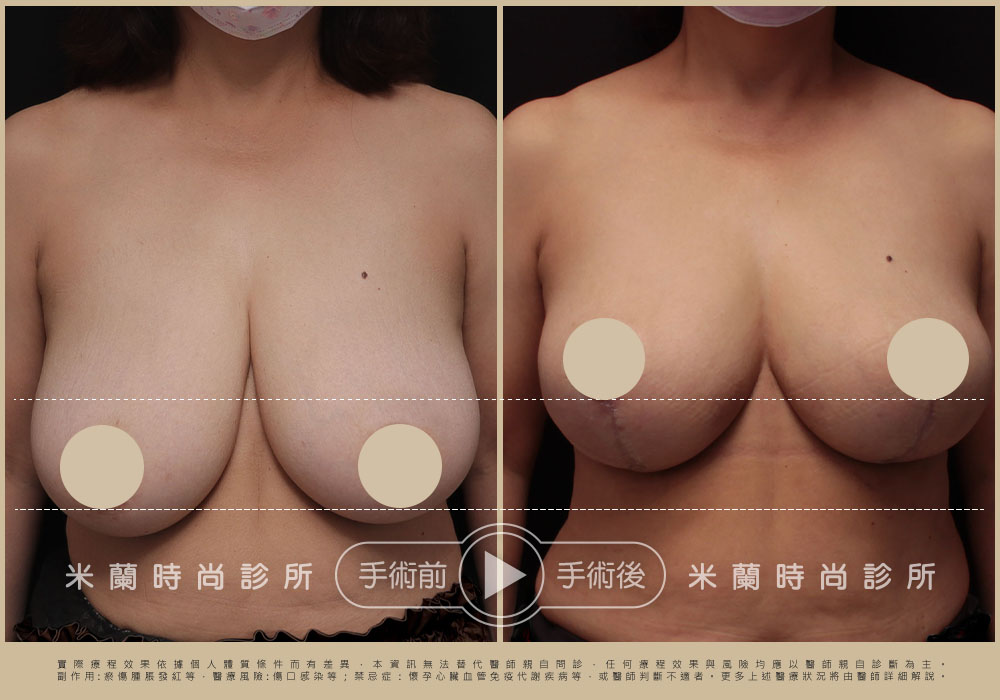 I型提乳手術案例