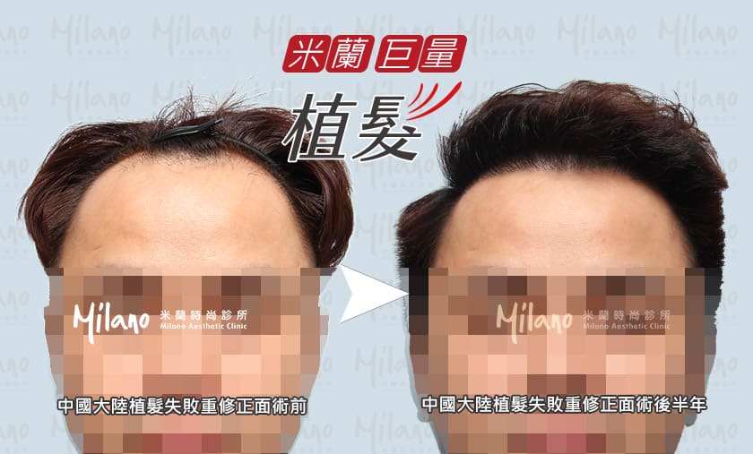 中國大陸植髮失敗重修正面術後半年比較