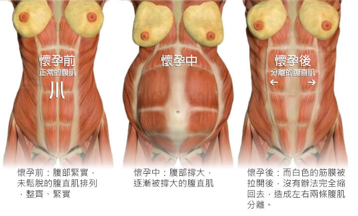 懷孕前後腹直肌以及腹直肌筋膜變化